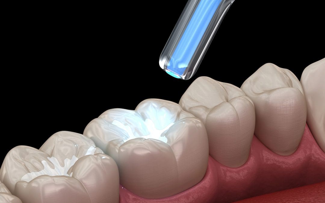 Composite vs Amalgam Fillings Comparison: Which One Is Right for You?